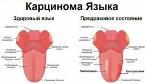 Рак языка реферат